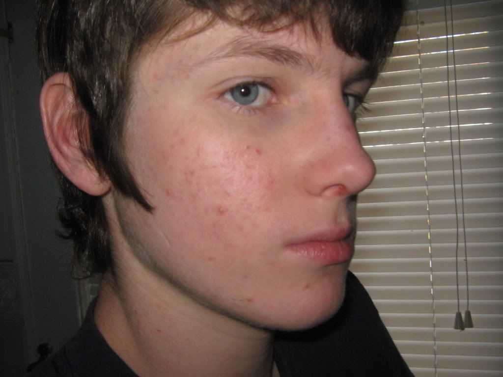 facial-redness-and-red-acne-marks-scars-help-rosacea-facial