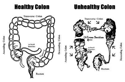 Healthy ans unhealthy colon